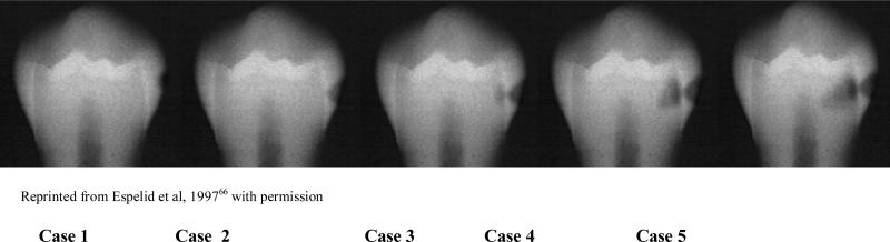 تسوس بين الأسنان